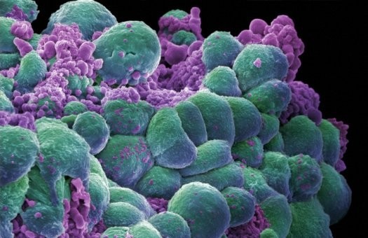 Рак - это грибковая инфекция; ненормальное деление клеток - выдумка.